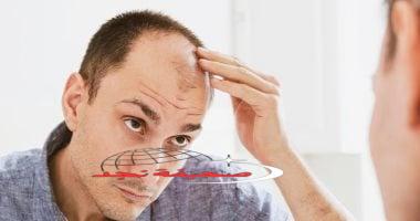 «بشرة رأس جديدة!» علماء يطورون علاجا مبتكرا للصلع.. وإطلاقه بحلول عام 2029