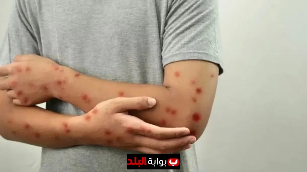 غينيا تستقبل 20000 جرعة من لقاح جدري القرود لتعزيز جهود الصحة العامة