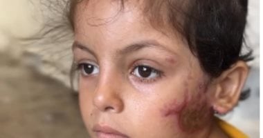 سفر الطفلة جود ماضي للعلاج خارج غزة بعد نشر “اليوم السابع” قصة إصابتها