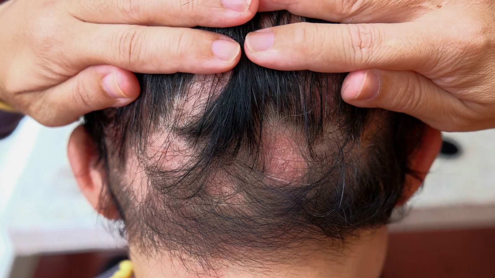 علاجات طبيعية ومنزلية للثعلبة والصلع في مقدمة الرأس