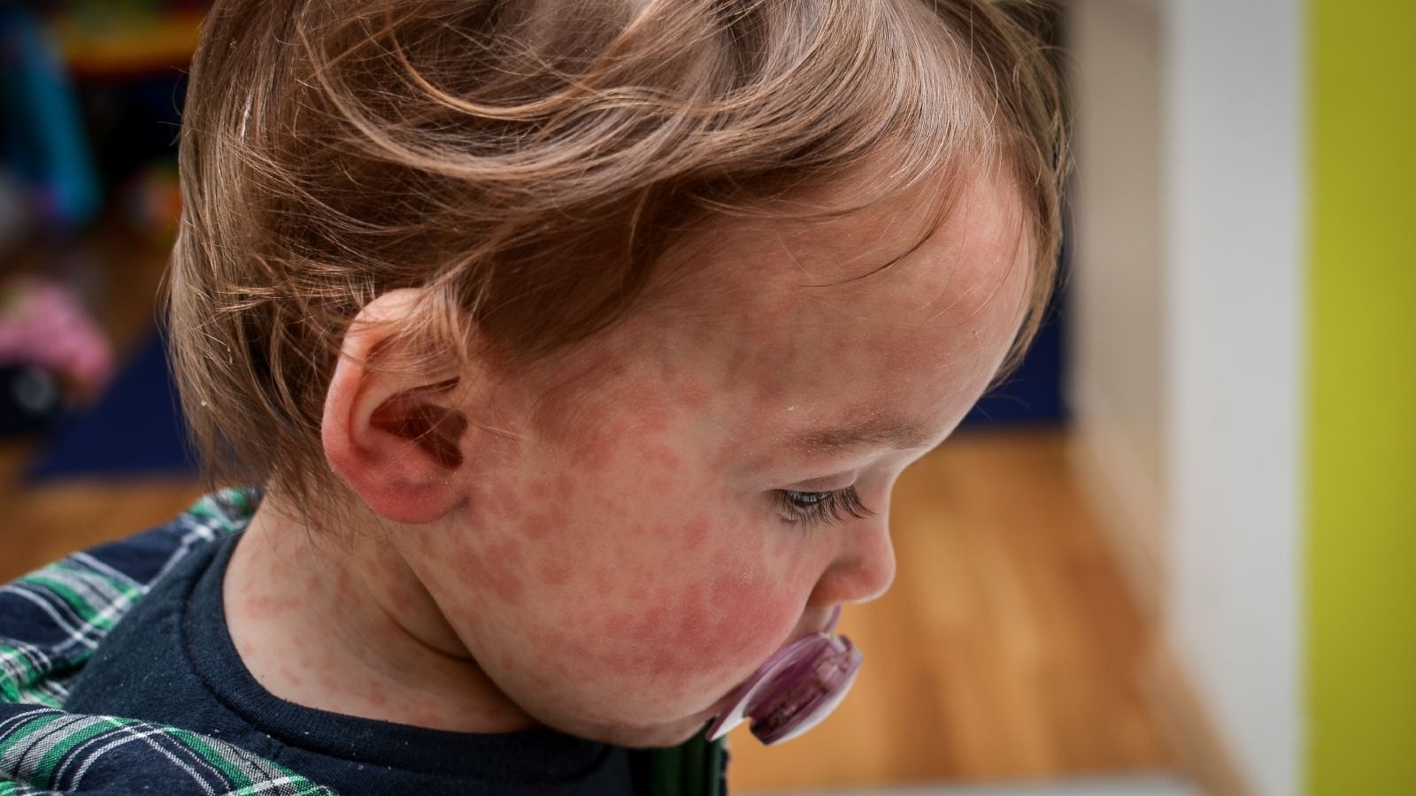 مرض الحصبة: الأعراض، طرق الانتقال، التشخيص، العلاج