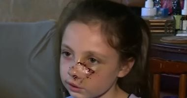 طفلة تتعرض لهجوم مروّع من كلب فى ألاباما.. جروح خطيرة وصدمة فى المجتمع المحلى