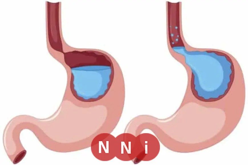الشاي والقهوة: أسباب محتملة لارتجاع المريء، طبيب يشرح العوامل المؤثرة