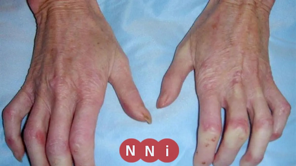 تفشي فيروس جلدي في مدرسة بالجيزة تعليم الجيزة يصدر توضيحًا عاجلًا ويتخذ إجراء سريعًا